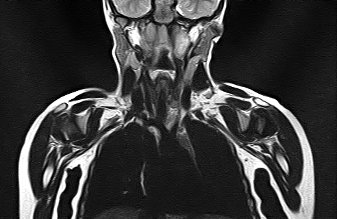 File:Bilateral Sprengel deformity with Klippel-Feil syndrome (Radiopaedia 66395-75650 Coronal T2 10).jpg