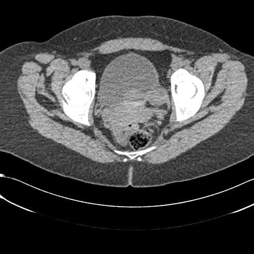 File:Bilateral acetabular protrusion with pincer type femoro-acetabular impingement (Radiopaedia 30134-30733 AXIAL SOFT THIN 34).jpg