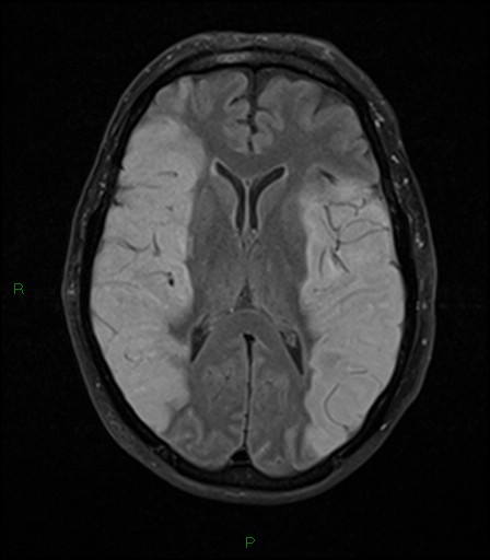 File:Bilateral acute middle cerebral artery territory infarcts (Radiopaedia 77319-89402 Axial FLAIR 13).jpg