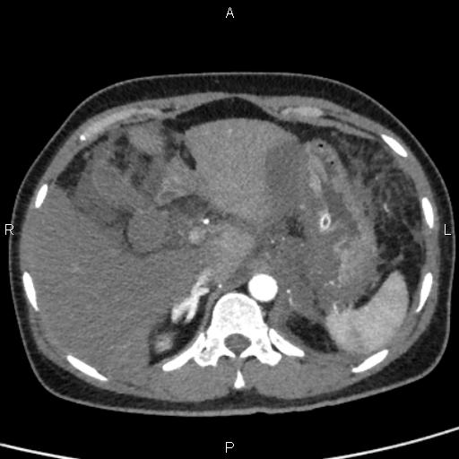 Bilateral adrenal gland hyperenhancement in pancreatitis (Radiopaedia 86642-102753 B 29).jpg