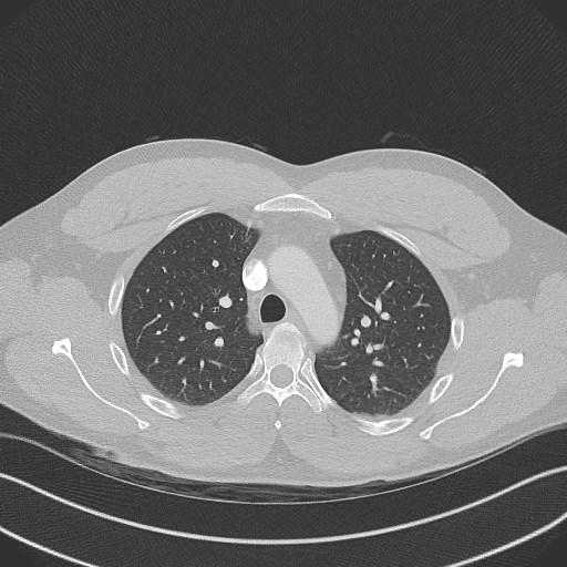 Bilateral atelectasis (Radiopaedia 48666-53675 Axial lung window 33).jpg
