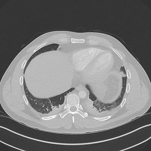 Bilateral atelectasis (Radiopaedia 48666-53675 Axial lung window 87).jpg