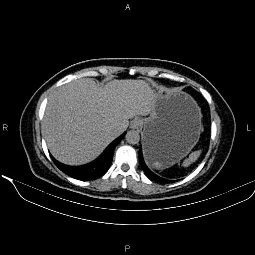 File:Bilateral benign adrenal adenomas (Radiopaedia 86912-103124 Axial non-contrast 22).jpg