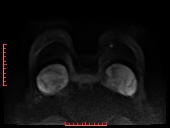 File:Bilateral breast implant rupture (Radiopaedia 24761-25027 DWI 25).jpg