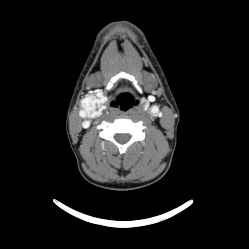 Bilateral carotid body tumors (Radiopaedia 52899-58827 A 5).jpg