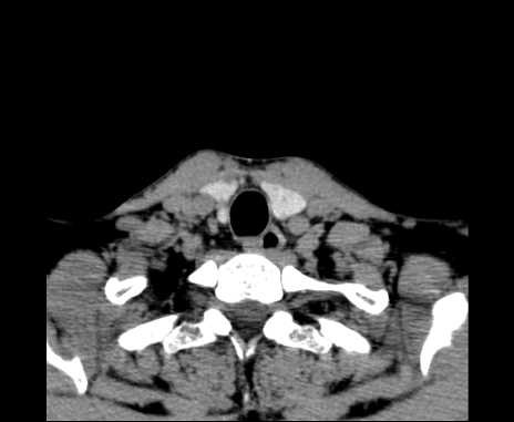 Bilateral carotid body tumors (Radiopaedia 61841-69870 Axial non-contrast 101).jpg