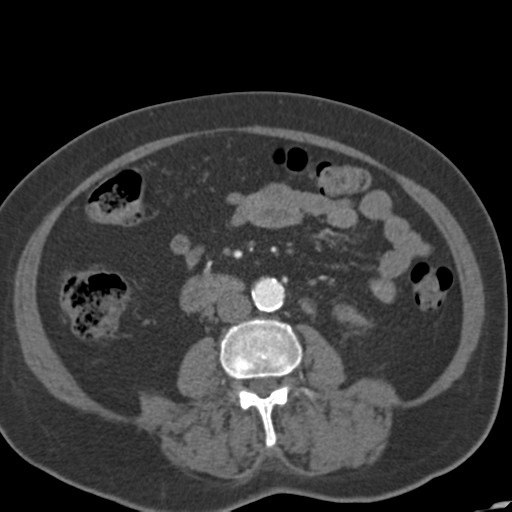 File:Bilateral delayed nephrogram from renal artery stenosis (Radiopaedia 47681-52362 A 32).png
