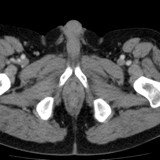 File:Bilateral direct inguinal herniae (Radiopaedia 17016-16719 B 28).jpg