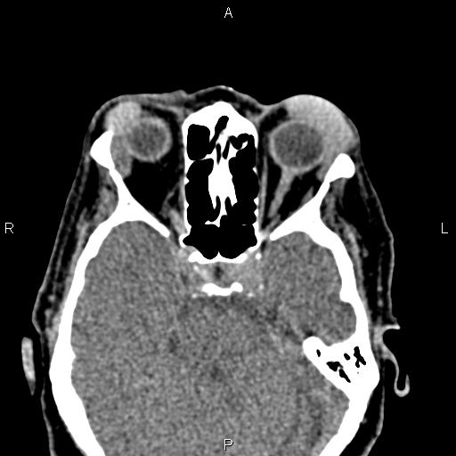 Bilateral enlargement of lacrimal glands - sarcoidosis (Radiopaedia 62627-70921 Axial non-contrast 49).jpg