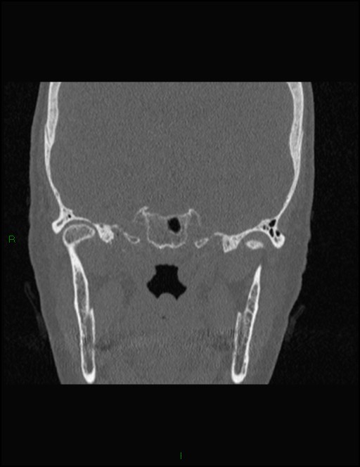 Bilateral frontal mucoceles (Radiopaedia 82352-96454 Coronal 265).jpg