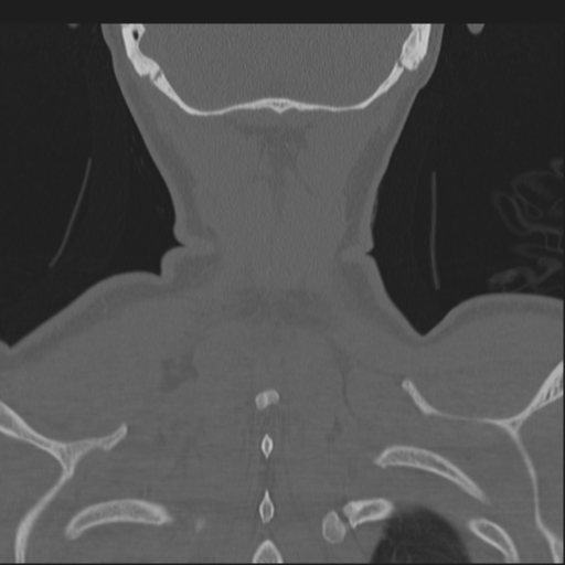 Bilateral locked facets (Radiopaedia 33850-35016 Coronal bone window 81).png