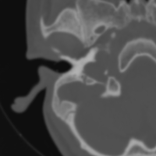 Bilateral otosclerosis (Radiopaedia 57237-64157 B 31).jpg