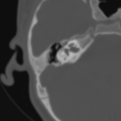 Bilateral otosclerosis (Radiopaedia 57237-64157 B 62).jpg