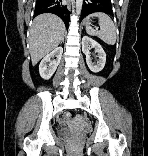 Bilateral ovarian dermoid cysts (Radiopaedia 85785-101603 C 39).jpg