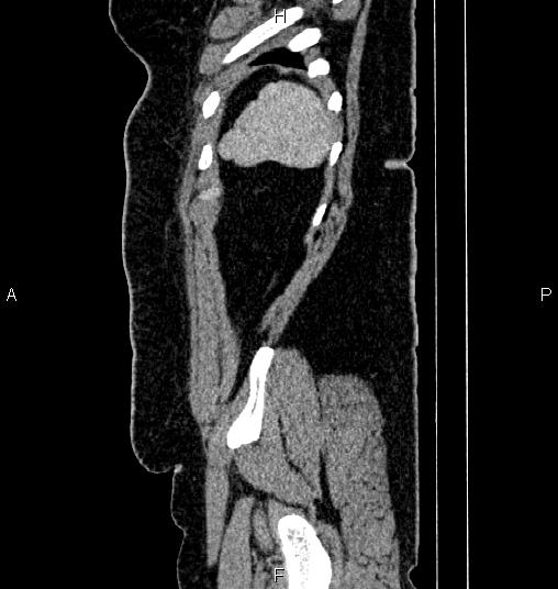 Bilateral ovarian dermoid cysts (Radiopaedia 85785-101603 D 88).jpg