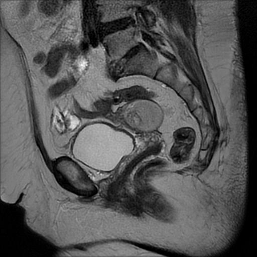 File:Bilateral ovarian dermoid cysts (Radiopaedia 90152-107338 Sagittal T2 11).jpg