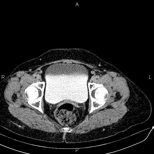 Bilateral ovarian serous cystadenocarcinoma (Radiopaedia 86062-101989 Axial C+ delayed 76).jpg