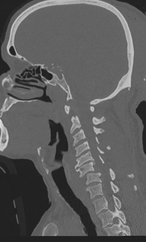Bilateral perched facet joint (Radiopaedia 63149-71669 Sagittal bone window 38).jpg