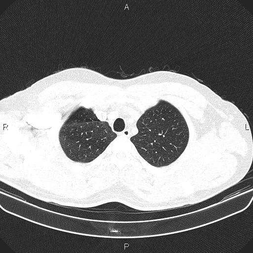 File:Bilateral pulmonary AVM (Radiopaedia 83134-97505 Axial lung window 13).jpg