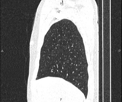 Bilateral pulmonary AVM (Radiopaedia 83134-97505 Sagittal lung window 28).jpg