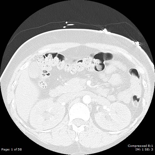 Bilateral pulmonary emboli with Hampton hump sign (Radiopaedia 54070-60246 Axial lung window 1).jpg