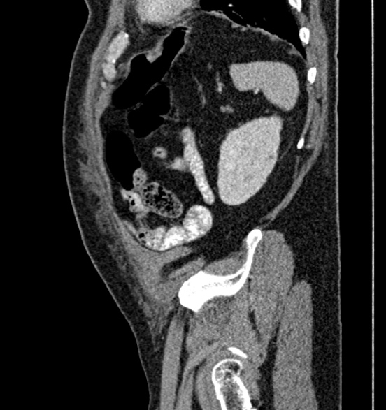 Bilateral rectus sheath hematomas (Radiopaedia 50778-56252 B 65).jpg