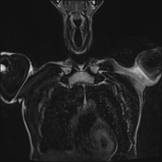 File:Bilateral spinoglenoid notch ganglion cysts (Radiopaedia 29577-30082 Coronal T2 21).jpg
