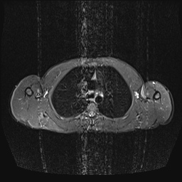 File:Bilateral spinoglenoid notch ganglion cysts (Radiopaedia 29577-30082 E 15).jpg