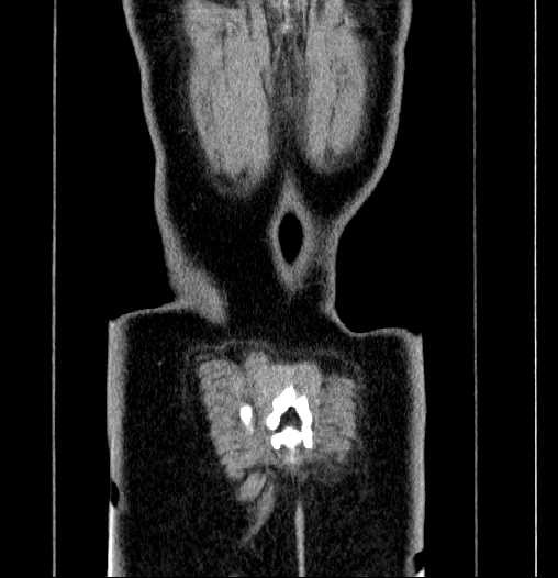 Blind-ending branch of a bifid ureter (Radiopaedia 61159-69048 F 69).jpg