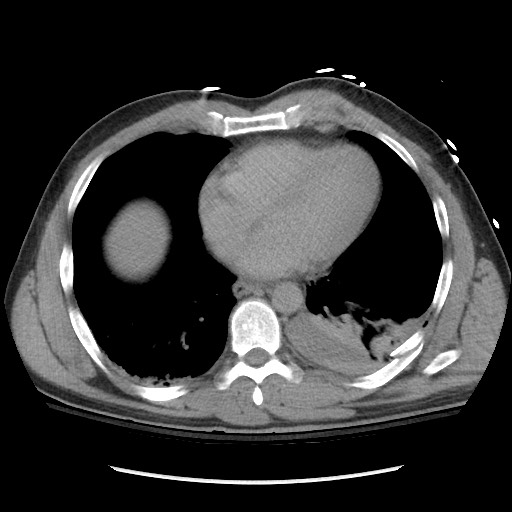 File:Blunt abdominal trauma with solid organ and musculoskelatal injury with active extravasation (Radiopaedia 68364-77895 Axial C+ delayed 8).jpg