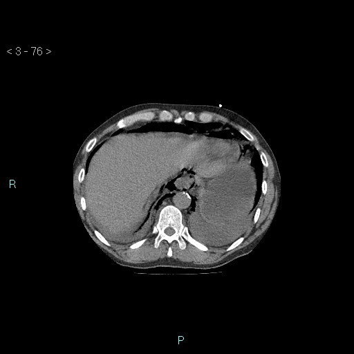 Boerhaave syndrome (Radiopaedia 27683-27897 Axial non-contrast 76).jpg
