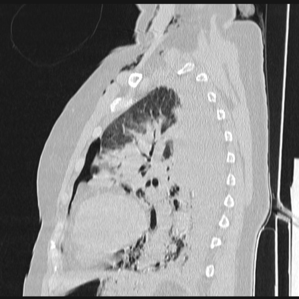 Boerhaave syndrome (Radiopaedia 45644-49799 Sagittal lung window 56).jpg