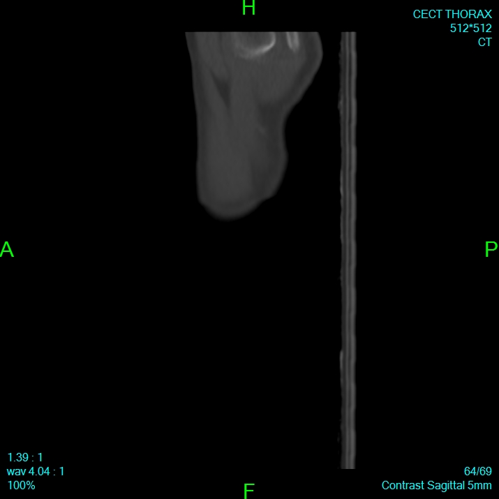 Bone metastases from lung carcinoma (Radiopaedia 54703-60937 Sagittal bone window 64).jpg