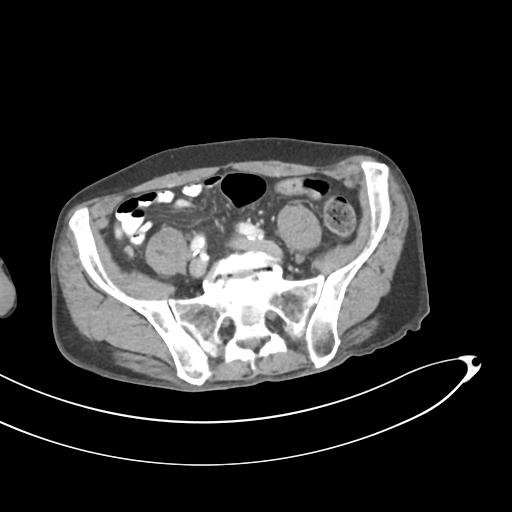 Bone metastasis from squamous cell carcinoma (Radiopaedia 30133-30730 B 54).jpg