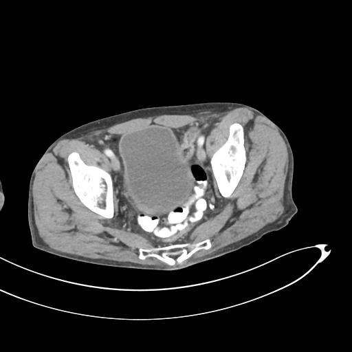 Bone metastasis from squamous cell carcinoma (Radiopaedia 30133-30730 B 67).jpg