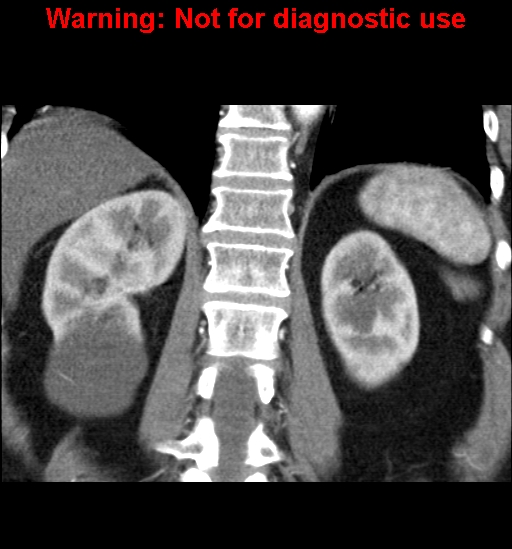 File:Bosniak renal cyst - type II (Radiopaedia 23404-23468 C 19).jpg