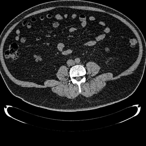 Bosniak renal cyst - type IV (Radiopaedia 24244-24518 Axial non-contrast 207).jpg
