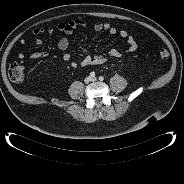 Bosniak renal cyst - type IV (Radiopaedia 24244-24518 C 250).jpg