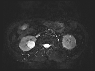 File:Bouveret syndrome (Radiopaedia 61017-68856 Axial MRCP 39).jpg