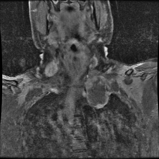 File:Brachial plexus neurofibroma (Radiopaedia 28030-28291 H 2).png