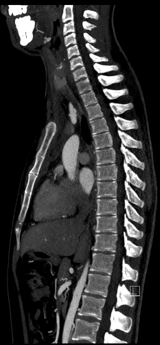 Brachiocephalic trunk pseudoaneurysm (Radiopaedia 70978-81191 C 48).jpg