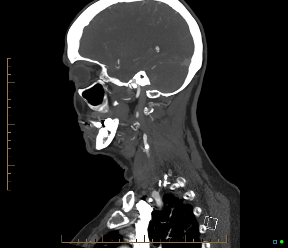 Brachiocephalic trunk stenosis (Radiopaedia 87242-103519 C 47).jpg