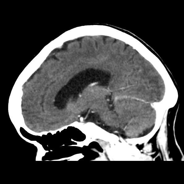 File:Brain metastases from breast cancer (Radiopaedia 23178-23231 C 28).jpg