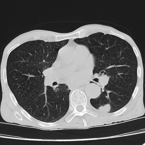 Brain metastases from lung cancer (Radiopaedia 27849-28093 Axial lung window 33).jpg