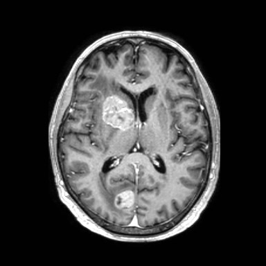 Brain metastases from lung cancer (Radiopaedia 83839-99028 Axial T1 C+ 35).jpg