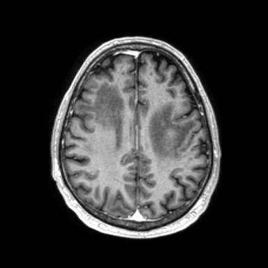 File:Brain metastases from lung cancer (Radiopaedia 83839-99028 Axial T1 C+ 46).jpg