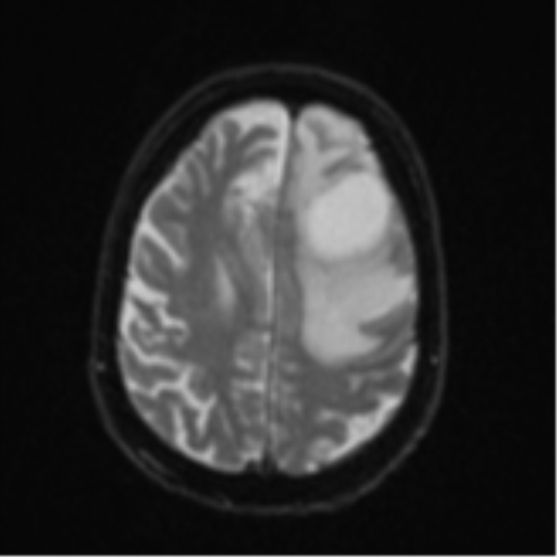 File:Brain metastasis (lung cancer) (Radiopaedia 48289-53179 Axial DWI 21).png
