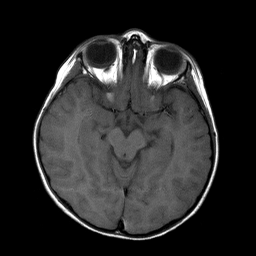 File:Brainstem ganglioglioma (Radiopaedia 10763-11224 Axial T1 12).jpg