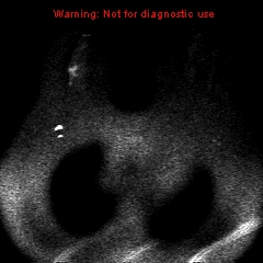 File:Breast carcinoma (multicentric multifocal in mammary Paget disease) (Radiopaedia 50966-56512 Axial DWI 17).jpg