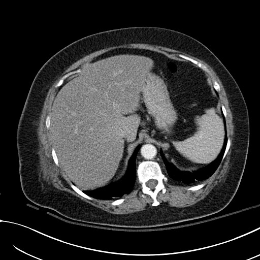Breast carcinoma with pathological hip fracture (Radiopaedia 60314-67974 A 48).jpg